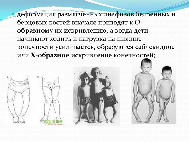  деформация размягченных диафизов бедренных и берцовых костей вначале приводят к Ообразному их искривлению,