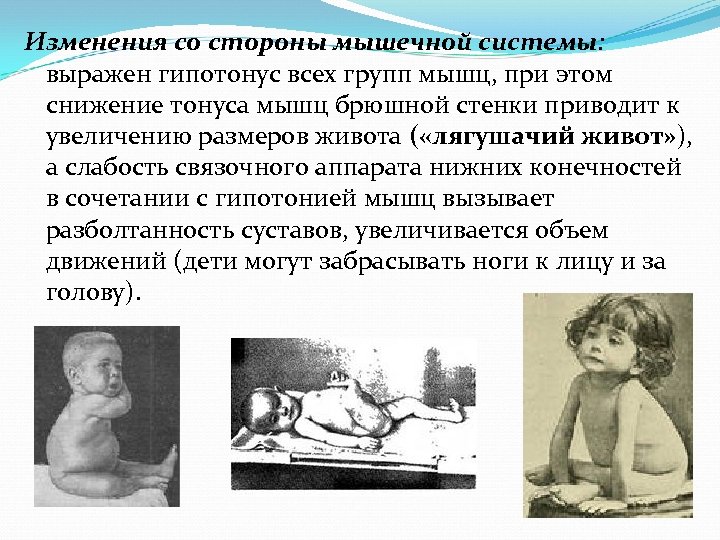 Изменения со стороны мышечной системы: выражен гипотонус всех групп мышц, при этом снижение тонуса