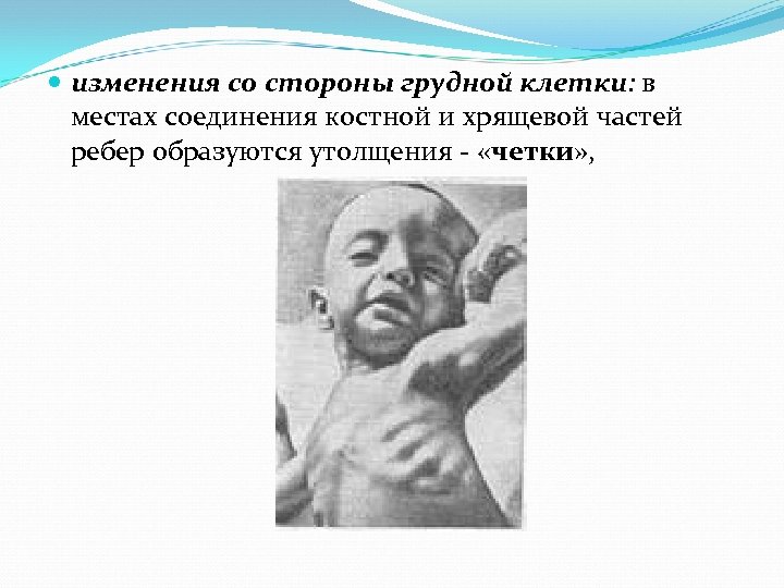  изменения со стороны грудной клетки: в местах соединения костной и хрящевой частей ребер