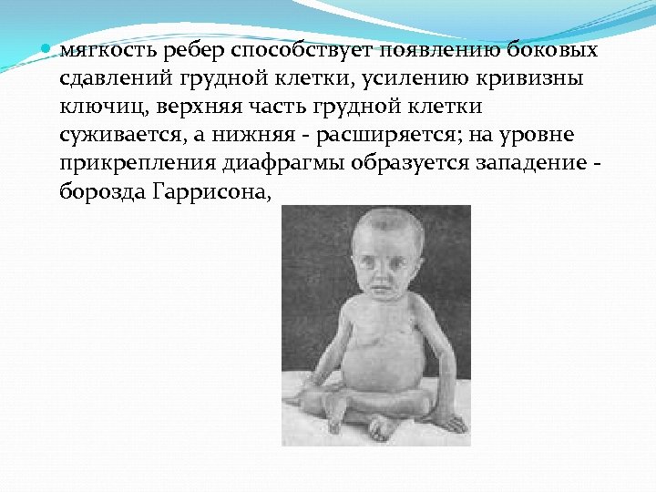  мягкость ребер способствует появлению боковых сдавлений грудной клетки, усилению кривизны ключиц, верхняя часть