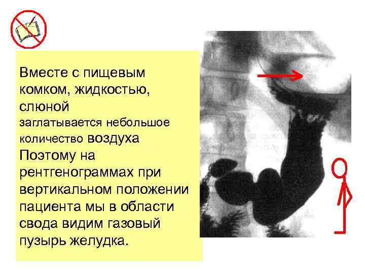 Вместе с пищевым комком, жидкостью, слюной заглатывается небольшое количество воздуха Поэтому на рентгенограммах при