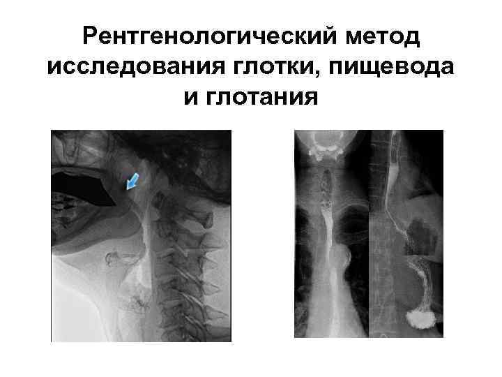 Рентгенологический метод исследования глотки, пищевода и глотания 