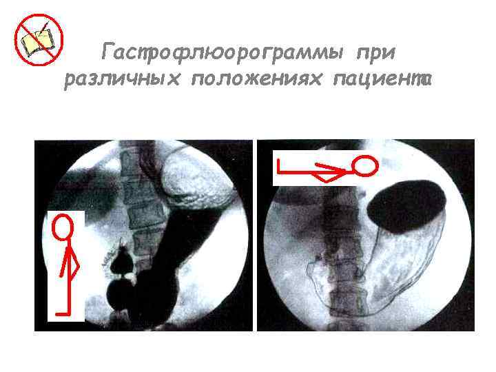 Гастрофлюорограммы при различных положениях пациента 