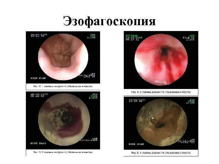 Эзофагоскопия 