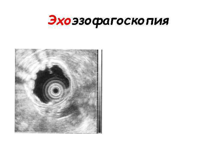 Эхоэзофагоскопия 