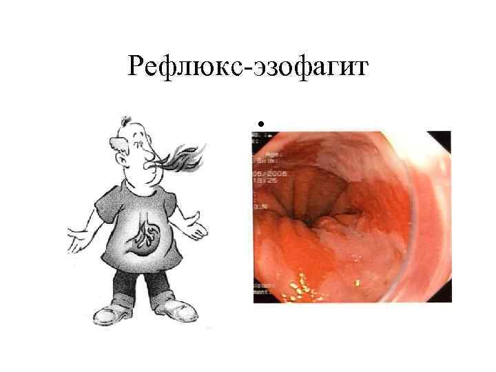 Рефлюкс-эзофагит • 
