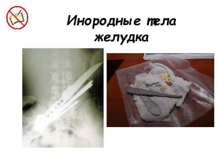 Инородные тела желудка 