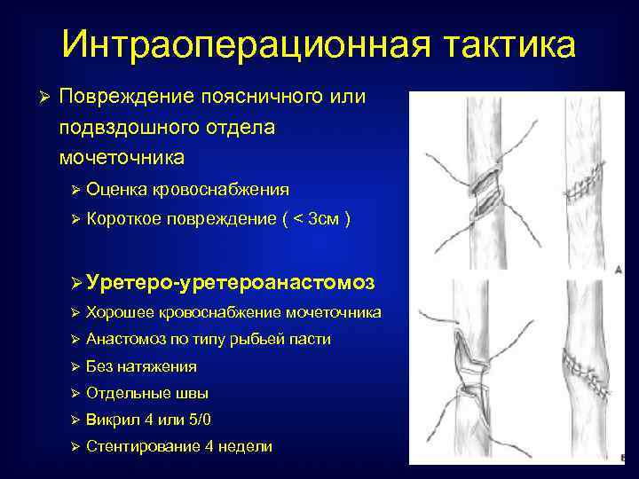 После пластики мочеточника. Уретеро-уретеро анастомоз. Анастомоз мочеточника. Шов мочеточника топографическая анатомия.