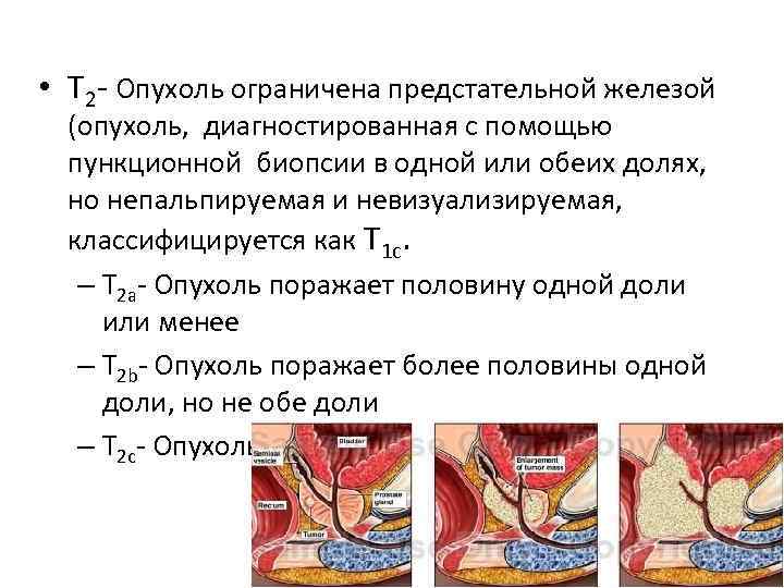  • Т 2 - Опухоль ограничена предстательной железой (опухоль, диагностированная с помощью пункционной