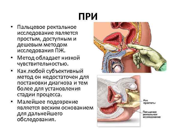 ПРИ • Пальцевое ректальное исследование является простым, доступным и дешевым методом исследования ПЖ. •