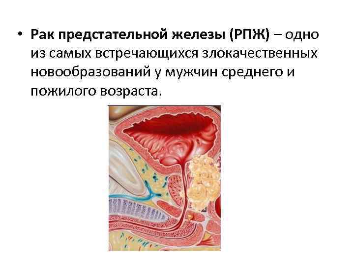  • Рак предстательной железы (РПЖ) – одно из самых встречающихся злокачественных новообразований у
