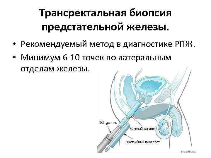 Трансректальная биопсия предстательной железы. • Рекомендуемый метод в диагностике РПЖ. • Минимум 6 -10
