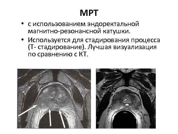 МРТ • с использованием эндоректальной магнитно-резонансной катушки. • Используется для стадирования процесса (Т- стадирование).