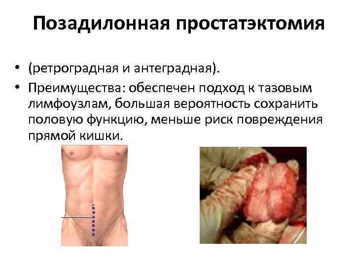 Позадилонная простатэктомия • (ретроградная и антеградная). • Преимущества: обеспечен подход к тазовым лимфоузлам, большая