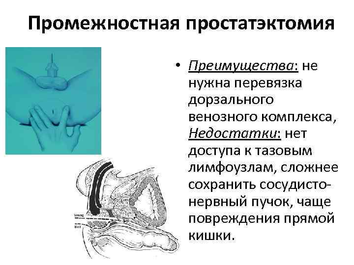 Промежностная простатэктомия • Преимущества: не нужна перевязка дорзального венозного комплекса, Недостатки: нет доступа к