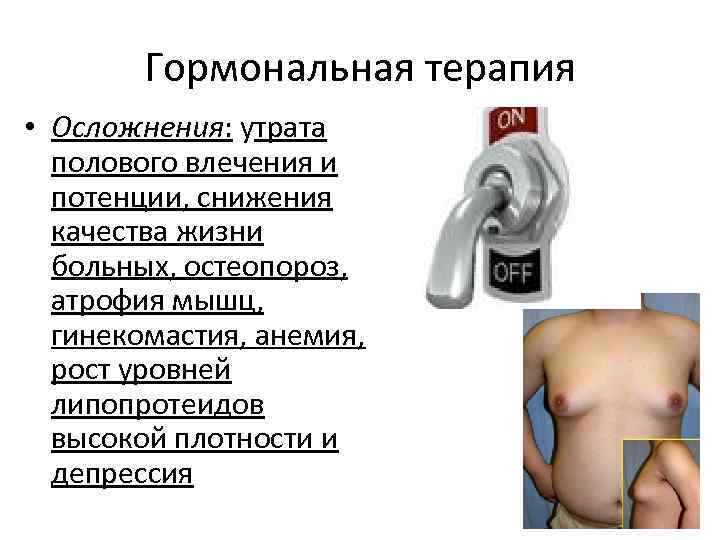 Гормональная терапия • Осложнения: утрата полового влечения и потенции, снижения качества жизни больных, остеопороз,
