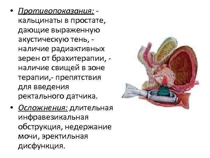  • Противопоказания: кальцинаты в простате, дающие выраженную акустическую тень, наличие радиактивных зерен от