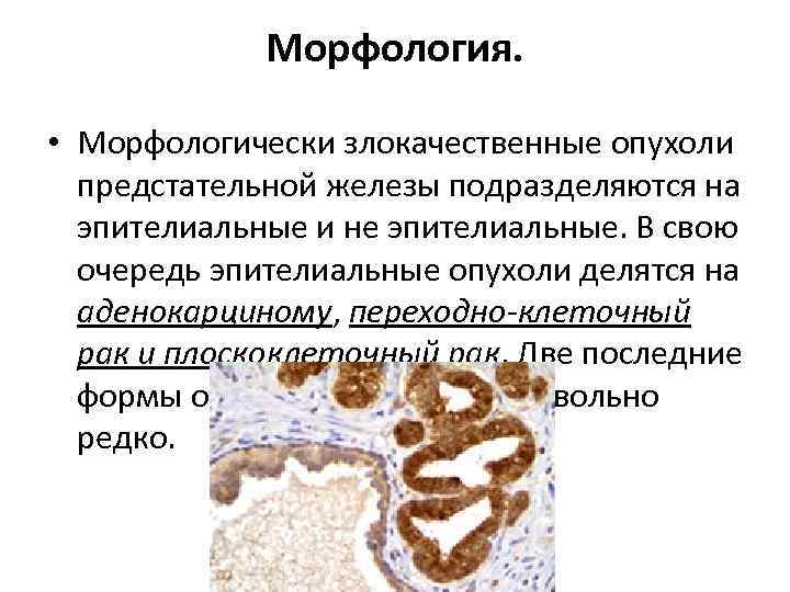 Морфология. • Морфологически злокачественные опухоли предстательной железы подразделяются на эпителиальные и не эпителиальные. В