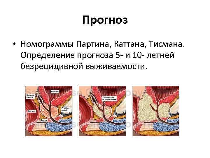 Прогноз • Номограммы Партина, Каттана, Тисмана. Определение прогноза 5 - и 10 - летней