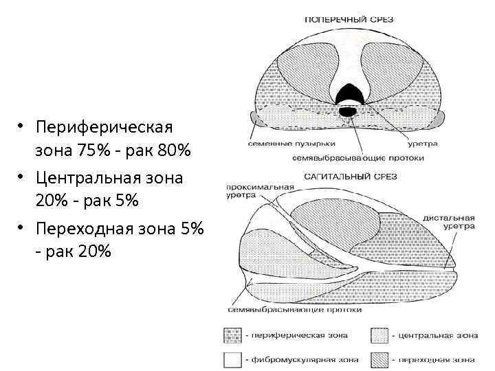  • Периферическая зона 75% - рак 80% • Центральная зона 20% - рак