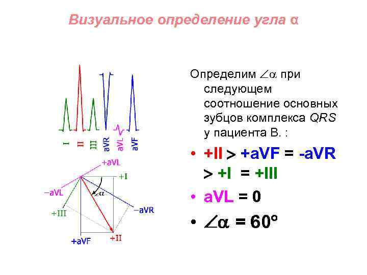 Визуальное определение угла α Определим при следующем соотношение основных зубцов комплекса QRS у пациента