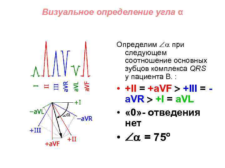 Визуальное определение угла α Определим при следующем соотношение основных зубцов комплекса QRS у пациента