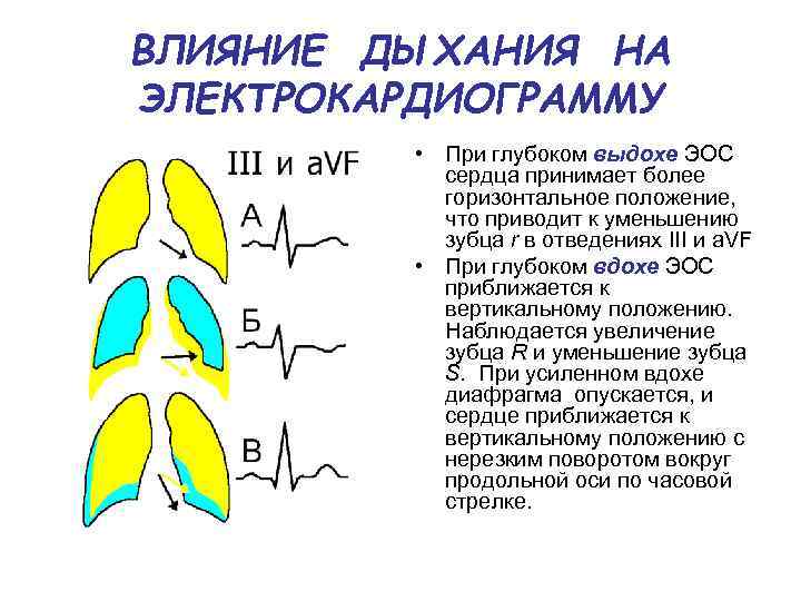 ВЛИЯНИЕ ДЫХАНИЯ НА ЭЛЕКТРОКАРДИОГРАММУ • При глубоком выдохе ЭОС сердца принимает более горизонтальное положение,