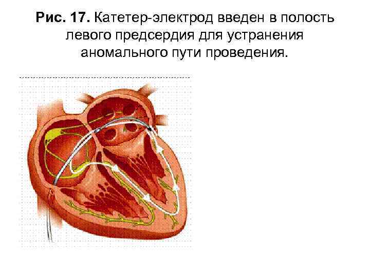 Рис. 17. Катетер электрод введен в полость левого предсердия для устранения аномального пути проведения.