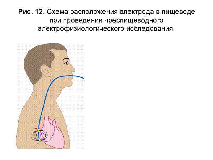 Рис. 12. Схема расположения электрода в пищеводе при проведении чреспищеводного электрофизиологического исследования. 