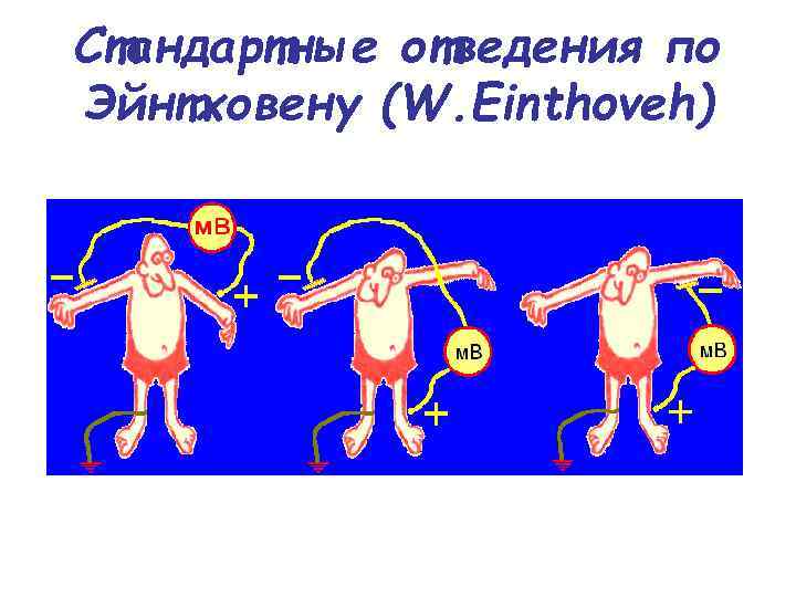 Стандартные отведения по Эйнтховену (W. Einthoveh) 