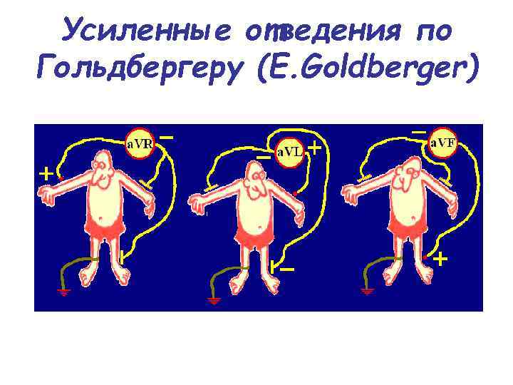 Усиленные отведения по Гольдбергеру (E. Goldberger) 