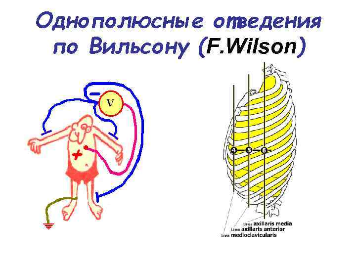 Однополюсные отведения по Вильсону (F. Wilson) 