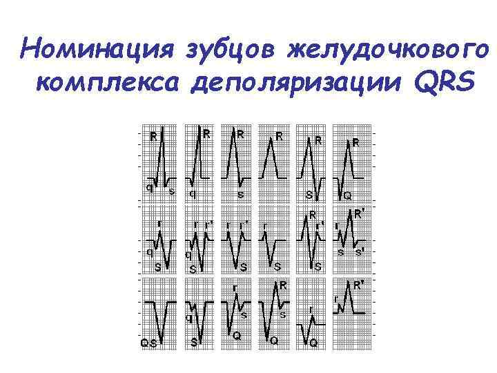 Номинация зубцов желудочкового комплекса деполяризации QRS 