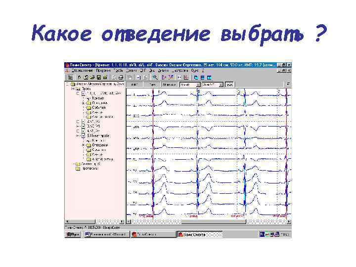 Какое отведение выбрать ? 