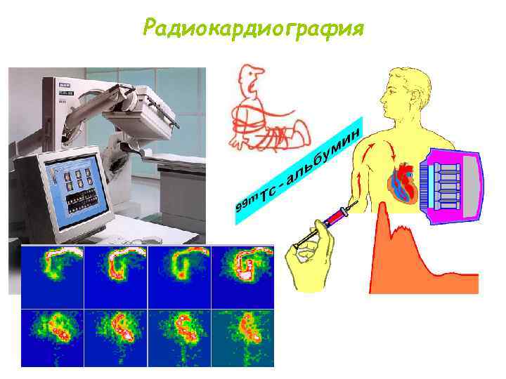 Радиокардиография 