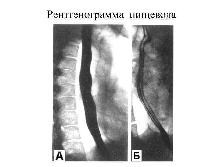 Рентгенограмма пищевода 