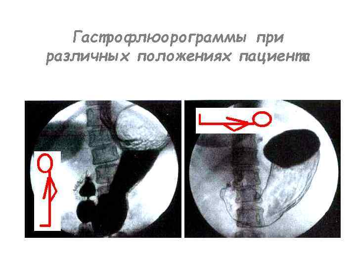 Гастрофлюорограммы при различных положениях пациента 