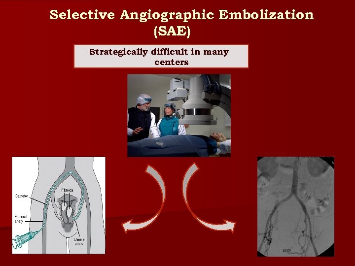 Selective Angiographic Embolization (SAE) Strategically difficult in many centers 