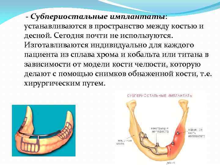  - Субпериостальные имплантаты: устанавливаются в пространство между костью и десной. Сегодня почти не