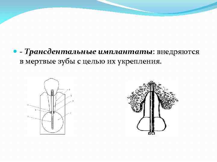  - Трансдентальные имплантаты: внедряются в мертвые зубы с целью их укрепления. 