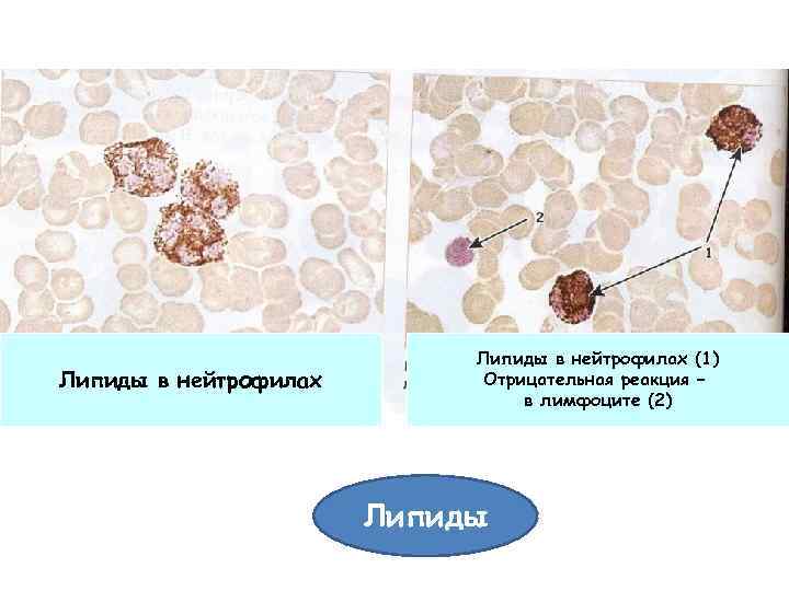 Липиды в нейтрофилах (1) Отрицательная реакция – в лимфоците (2) Липиды 