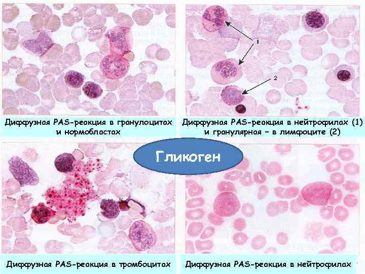Диффузная PAS-реакция в гранулоцитах и нормобластах Диффузная PAS-реакция в нейтрофилах (1) и гранулярная –