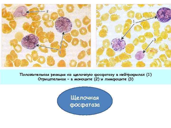 Положительная реакция на щелочную фосфатазу в нейтрофилах (1) Отрицательная – в моноците (2) и