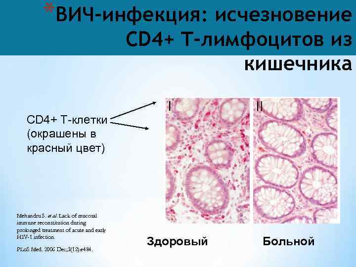 *ВИЧ-инфекция: исчезновение CD 4+ T-лимфоцитов из кишечника CD 4+ T-клетки (окрашены в красный цвет)