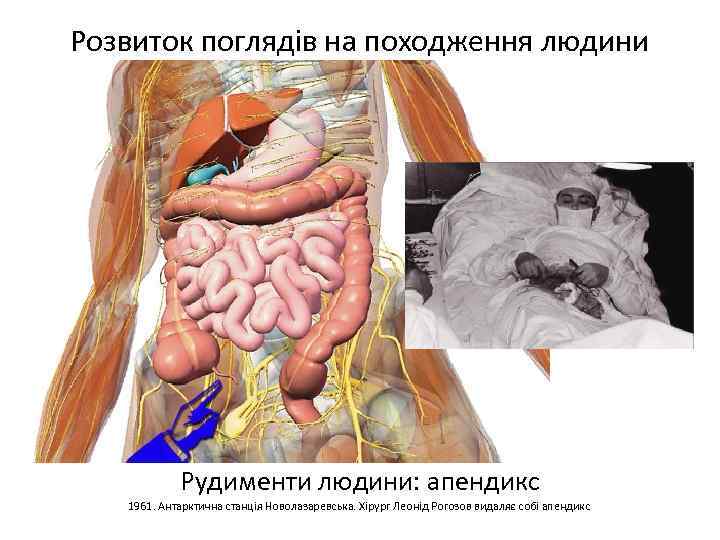 Розвиток поглядів на походження людини Рудименти людини: апендикс 1961. Антарктична станція Новолазаревська. Хірург Леонід