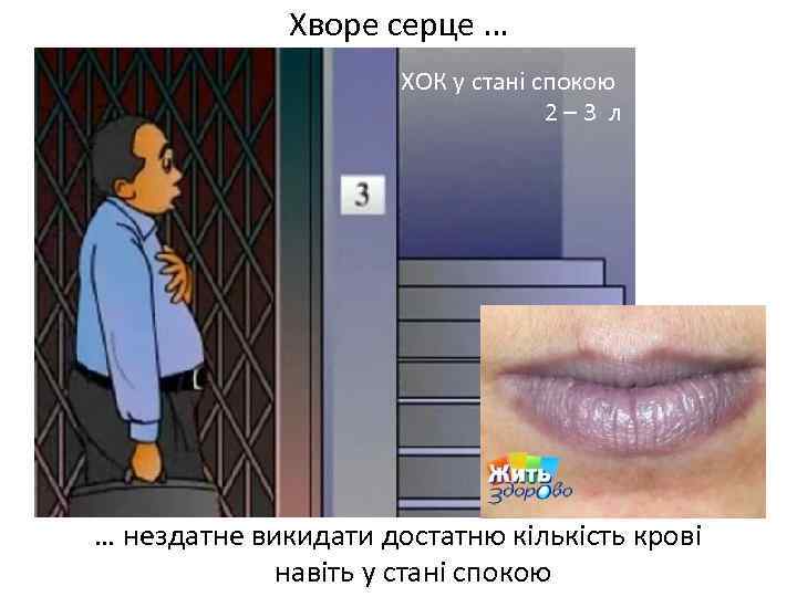 Хворе серце … ХОК у стані спокою 2– 3 л … нездатне викидати достатню