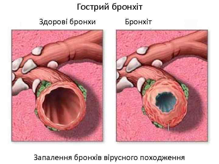 Гострий бронхіт Здорові бронхи Бронхіт Запалення бронхів вірусного походження 