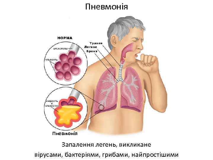 Пневмонія Запалення легень, викликане вірусами, бактеріями, грибами, найпростішими 