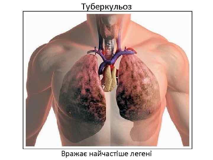 Туберкульоз Вражає найчастіше легені 