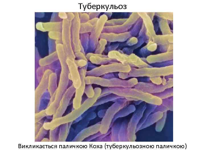 Туберкульоз Викликається паличкою Коха (туберкульозною паличкою) 
